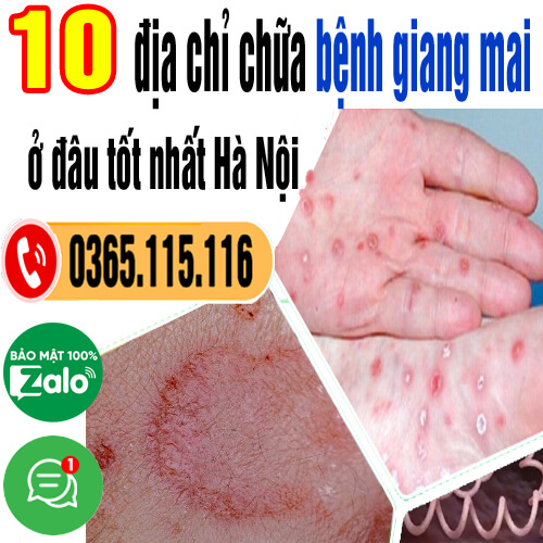 Top 10 địa chỉ chữa bệnh giang mai ở đâu tốt nhất Hà Nội