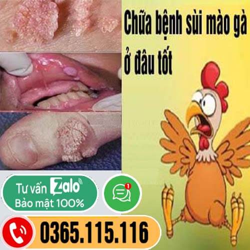 10 địa chỉ khám chữa bệnh sùi mào gà ở đâu tốt nhất tại Hà Nội