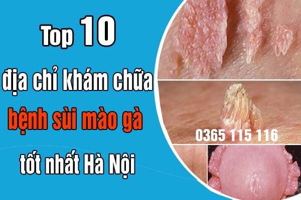 Top 10 địa chỉ khám chữa bệnh sùi mào gà ở đâu tốt nhất Hà Nội 2024