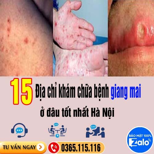 10 địa chỉ khám chữa bệnh giang mai ở đâu tốt nhất Hà Nội